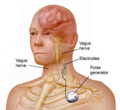 Vagus Nerve Stimulator - Natural Sleep