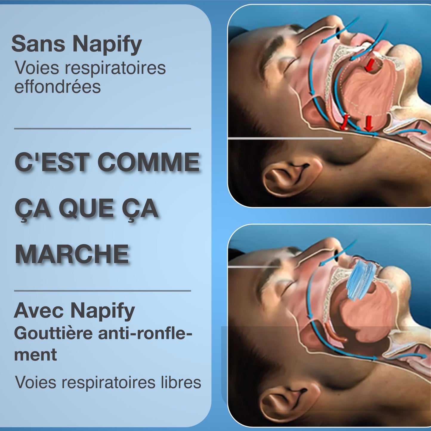 Attelle de ronflement contre le ronflement et le grincement Protège-dents anti-ronflement (attelle de morsure) enfin sans ronflement avec attelle dentaire - réglable comme chez le dentiste - Natural Sleep